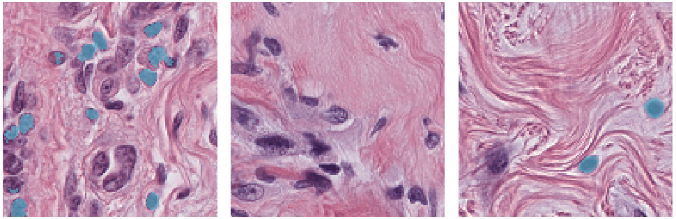 Segmented lymphocytes from breast cancer tissue images
